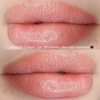 A woman's lips are shown before and after a treatment.