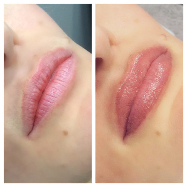A woman's lips before and after lip filler.