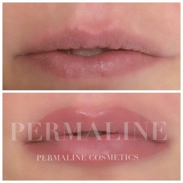 Permaline cosmetics before and after lip filler.